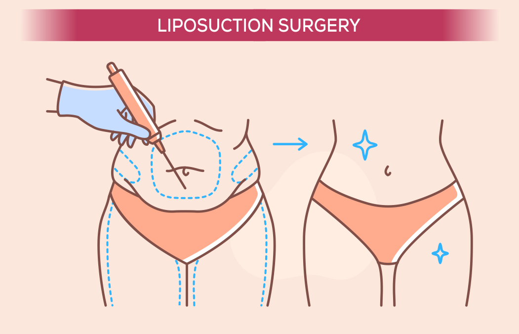 Λιποαναρρόφηση (ουδέτερη λήψη χειρουργείου)